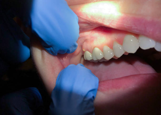 Best Emergency Care for Gum Disease in Breckenridge, MI